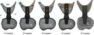 Modelos 3D. C: corona; I: implante; P: palatino; SM: seno maxilar; V: vestibular.