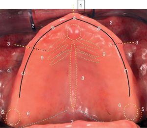Zones of distribution of ulcers in maxila: 1: Middle bottom bridle, 2: Anterior vestibular, 3: Side bridle, 4: Posterior vestibular flank, 5: Distovestibular area, 6: Piriformis papilla, 7: Posterior lingual flank, 8: Anterior lingual flank, 9: Lingual frenum, A: Corresponds to the high area of the flanges, located in relation to the insertion of the middle bottom bridle. B: Corresponds to the Upper flanges, located between the insertion of the middle bottom bridle and side bridle. C: Corresponds to the upper flanges, located distal to the insertion of the middle bottom bridle.