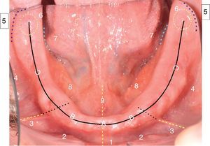 Zones of distribution of ulcers in mandible: 1: Medial lower frenulum, 2: Anterior vestibular flank, 3: Side bridle, 4: Posterior vestibular flank, 5: Distovestibular area, 6: Piriformis papilla, 7: Posterior lingual flank, 8: Anterior lingual flank, 9: Lingual frenulum, A: Corresponds to the high area of the flanges, located in relation to the place of insertion of the middle bottom bridle. B: Corresponds to Upper flanges, located between the insertion of the middle bottom bridle and side bridle. C: Corresponds to Upper flanges, located by distal to the insertion of the middle bottom bridle.