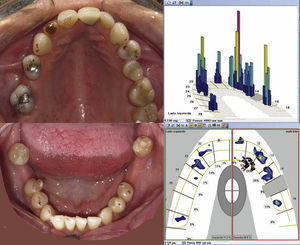 Comparación de los arcos dentarios con el registro en máxima intercuspidación, con Accufilm® II (Parquel). Imagen digital de T-Scan® III. Columna azul: fuerzas bajas. Columna roja: contactos fuertes.
