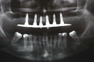 Postoperative panoramic radiograph after one year of surgery.