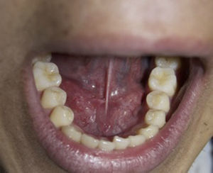 Imagen clínica tras 12 meses. Mucosa del piso de la boca indemne, sin signos de recidiva y con aspecto de brida cicatricial.