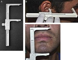 A. Craneómetro de Knebelman por su lado SET, con sus brazos, el superior fijo y el inferior móvil, con su tornillo de fijación. B. Procedimiento de medición con el craneómetro de Knebelman por su lado READ. C. Procedimiento de medición con el craneómetro de Knebelman por su lado SET.