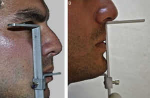 A. Procedimiento de medición con el compás de Willis desde el canto externo del ojo a la comisura. B. Procedimiento de medición con el compás de Willis desde subnasal al borde del mentón.