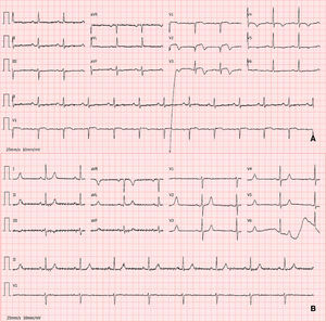 (A) Electrocardiogram on admission demonstrating ST-segment elevation in precordial leads. (B) Electrocardiogram at hospital discharge showing resolution of the abnormalities.