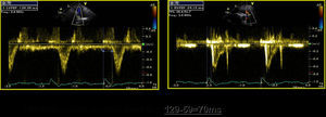 Dessincronia interventricular: diferencial entre os tempos de pré-ejecção dos fluxos pulmonar (129ms) e aórtico (59ms) de 70ms, avaliada por Doppler pulsado espectral.