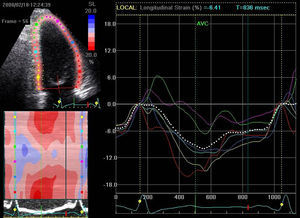 Imagem de strain pós CRT: desaparecimento do septal flash (curva amarela) e pico de strain da parede lateral «desviado» para a sístole – prévio ao encerramento da válvula aórtica (curva vermelha).