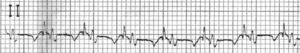 ECG tracing in lead II showing two different QRS complexes alternating at a rate of 176 bpm.