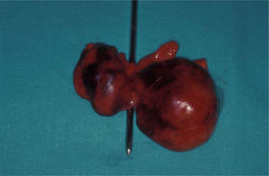 Autopsy examination of the conjoined heart, showing fusion of right atria, and relative hypoplasia of one twin's heart.
