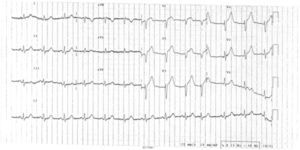 ECG na admissão a mostrar RS e ondas Q em V1 e V2 associado a supradesnivelamento de ST de V1-V5.