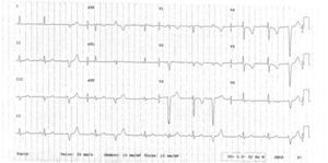 ECG 90 minutos após a fibrinólise a evidenciar inversão da onda T de V1 a V6.