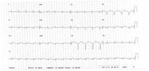 ECG após desfibrilação elétrica a revelar supradesnivelamento do segmento ST em DII, DIII e aVF.