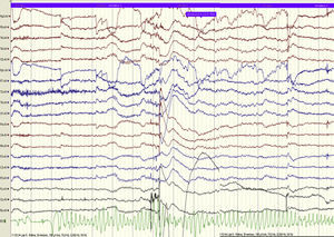 Taquicárdia ventricular polimórfica registada em ECG uniderivação durante video-EEG.