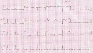 Traçado eletrocardiográfico com QTc de 482ms.