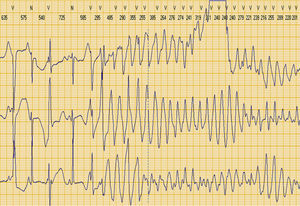 Taquicárdia ventricular polimórfica tipo torsade de pointes, registada em ECG de Holter de 24 horas.