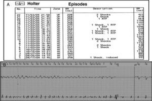 A-Registo de eventos do CDI mostrando várias detecções na zona de fibrilhação ventricular e 19 terapias adequadas (13 choques e 6 episódios de pacing anti-taquicardia); B-Electrograma com detecção na zona de fibrilhação ventricular com desfibrilhação com sucesso, após com choque de 40J.