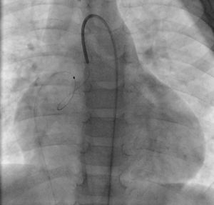 Formação de laçada arteriovenosa através da fístula coronária.