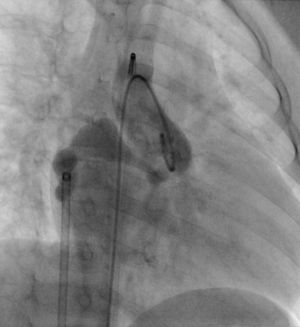 Após realizada a laçada arteriovenosa através da fístula, o encerramento é feito por via venosa, implantando o dispositivo na aurícula direita.