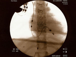 Imagem de fluoroscopia após revisão cirúrgica e substituição de pacemaker, mostrando sonda bem posicionada, com dipolo auricular bem colocado.