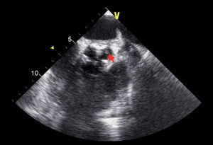 ETE: válvula aórtica em eixo curto com moderada calcificação e pequena vegetação apensa à cúspide coronária esquerda.