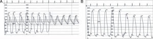 (A) Curvas hemodinâmicas registando o gradiente transvalvular aórtico de 20mmHg. (B) Curvas hemodinâmicas registando o gradiente intraventricular de 40mmHg entre o corpo do VE e o trato de saída do VE.