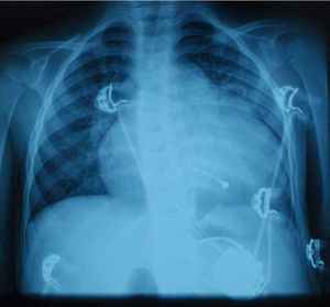 Telerradiografia de tórax PA (cardiomegalia, sinais de congestão pulmonar e sistema de pacemaker epicárdico VVI com gerador subcostal).