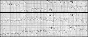 Eletrocardiograma inicial. Pace ventricular direito com QRS 180 ms. Dissociação aurículo-ventricular.