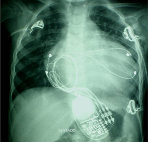 Telerradiografia de tórax mantendo cardiomegalia, mas existindo uma melhoria dos sinais de congestão pulmonar. Pacemaker biventricular epicárdico DDD com gerador subcostal.