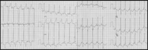 Eletrocardiograma em pacing biventricular. QRS: 120 ms.