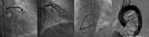 Coronary angiogram showing a right dominant system and no flow-limiting lesions. Filling pressures were elevated and cardiac output was preserved. The ascending aortogram showed no evidence of dissection.