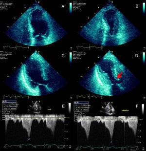 End-diastolic and end-systolic apical four-chamber (A and B) and three-chamber (C and D) echocardiographic views demonstrating the typical apical and mid-ventricular LV wall-motion abnormalities that raised the suspicion of Takotsubo cardiomyopathy. SAM of the mitral valve with LVOT obstruction is signaled by the red arrow (D). Continuous-wave Doppler profile outlining the degree of LVOT obstruction at rest (E) and during the Valsalva maneuver (F).