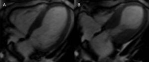 Cardiovascular magnetic resonance (CMR) in Takotsubo cardiomyopathy. End-diastolic (A) and end-systolic (B) frames from a four-chamber cine sequence demonstrate hyperdynamic function of basal segments with apical hypokinesia.