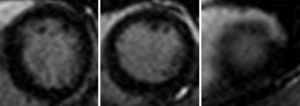 Absence of scar on short-axis late gadolinium-enhanced images.