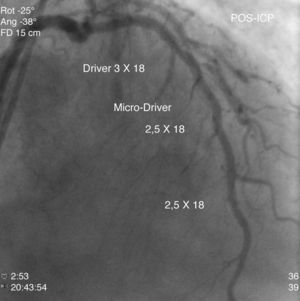 Coronariografia após implantação de 3 stents metálicos na DA.