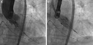 Implantação da prótese percutânea. A: visualiza-se uma aortografia com o stent com a prótese preso ao balão no trato de saída do ventrículo esquerdo. B: Balão completamente insuflado com prótese expandida na sua posição definitiva. Pace-maker e sonda de ecocardiografia transesofágica.