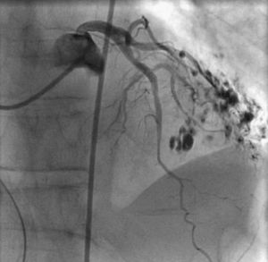 Coronary angiogram, right anterior oblique caudal view, with non-significant lesions in the left coronary artery. The opaque spots result from prior oral contrast aspiration during esophagography.