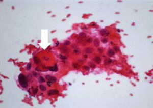 Cytology from computed tomography-guided needle aspiration biopsy (hematoxylin–eosin) revealing large epithelial cells, arranged in nests, with irregular, pleomorphic, central nuclei and dense cytoplasm. Keratin pearls (arrow) are also visible.