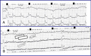 A) ECG durante episódio de dor pré-cordial. Observa-se supradesnivelamento ST nas derivações inferiores. B) ECG 6 minutos após NTG SL com normalização das alterações eletrocardiográficas.