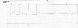 Registo eletocardiográfico em Holter 24h durante episódio de dor precordial - Ocorrência de supradesnivelamento de ST onde se regista episódio de BAV de alto grau com pausa na atividade elétrica ventricular de 4,4s.