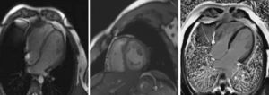Four-chamber (left) and short-axis (middle) steady-state free precession cine magnetic resonance image in end-diastole, confirming noncompaction of the left ventricle. Right: cardiac magnetic resonance four-chamber view after gadolinium administration, revealing no myocardial delayed enhancement.