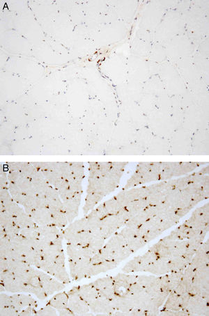 A e B - Ausência de imunomarcação da emerina em todos os núcleos das células musculares do caso índex (2A) comparada com o controlo (2B); 200X.