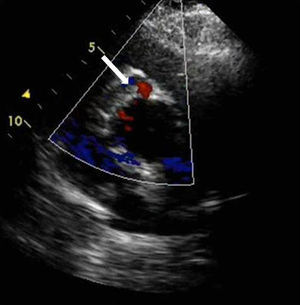 Incidência para-esternal esquerda, eixo curto, a nível da aorta, identificando-se uma imagem tubular (seta) circundando a aorta.