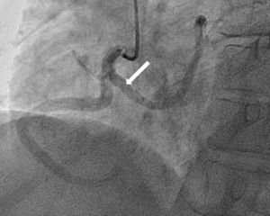 Angiografia coronária (incidência oblíqua anterior esquerda caudal): origem anómala da ACE (seta) com trajeto anterior à aorta.