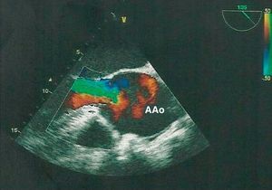 Imagem ecocardiográfica do aneurisma aórtico (AAo), com regurgitação aórtica grave associada.