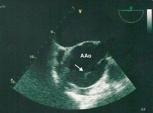 Imagem ecocardiográfica linear sugestiva de flap intimal aórtico (seta), em curto eixo. AAo: aneurisma aórtico.