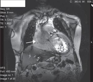 A ectasia anulo-aórtica visualizada em curto e longo (seta) eixo, respetivamente, por ressonância magnética cardíaca, exame que permitiu excluir a hipótese de dissecção aguda da aorta. AAo: aneurisma aórtico; AE: aurícula esquerda; VE: ventrículo esquerdo.