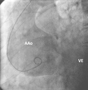 Aortografia do segmento aneurismático, limitado à raiz da aorta e aorta ascendente. AAo: aneurisma aórtico; VE: ventrículo esquerdo.
