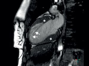 Imagem de RM onde se evidencia a hipertrofia (asterisco) e a hipertrabeculação (setas) miocárdicas.