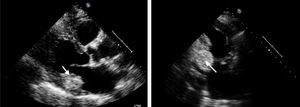 Two-dimensional echocardiogram, parasternal long-axis view (A) and apical two-chamber view (B), revealing an echodense mass at the base of the posterior leaflet.