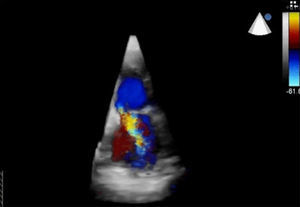 Three-dimensional transthoracic color flow imaging of mitral regurgitation, showing an eccentric jet originating from the posteromedial commissure.